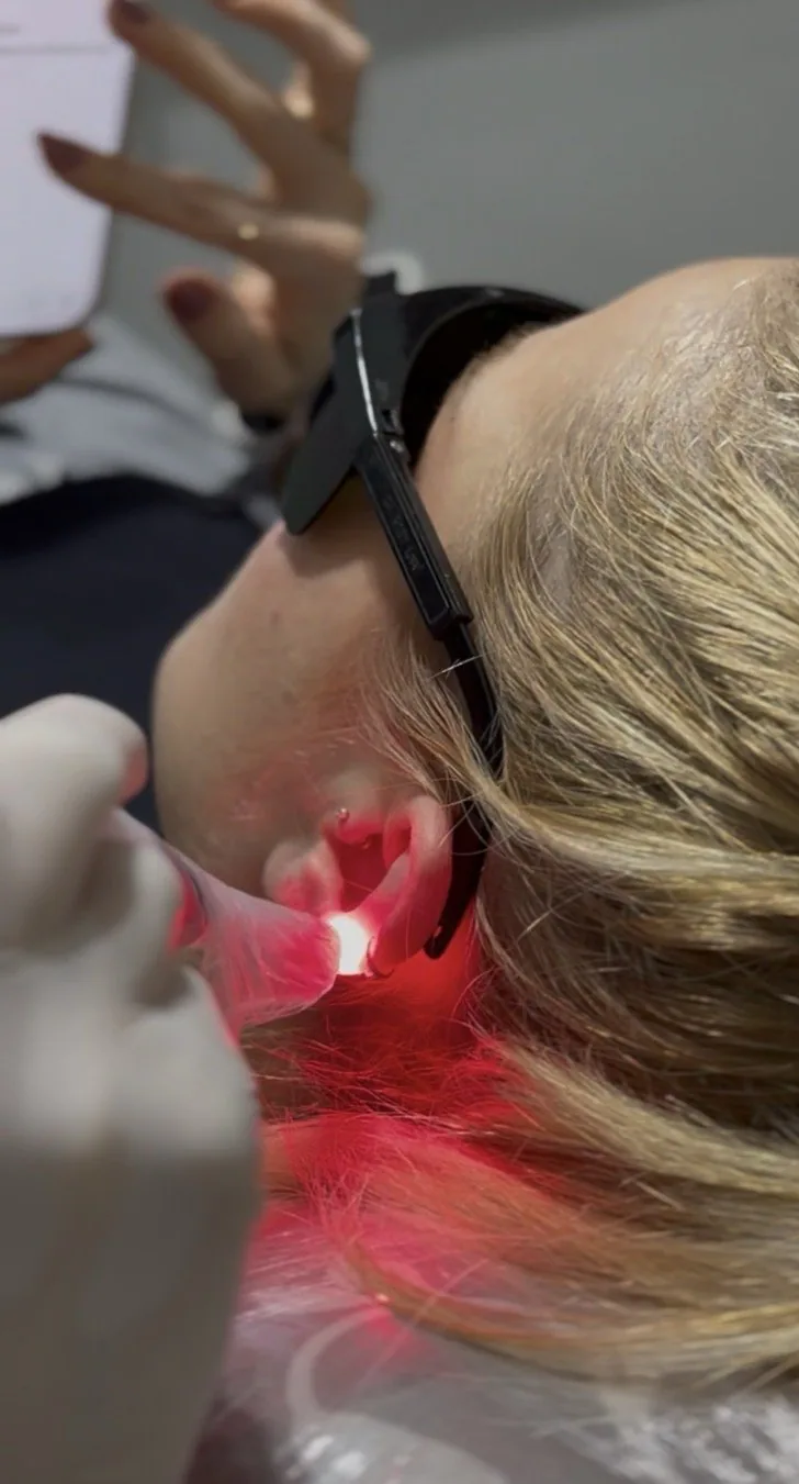 Sessão de laserterapia em piercing na orelha