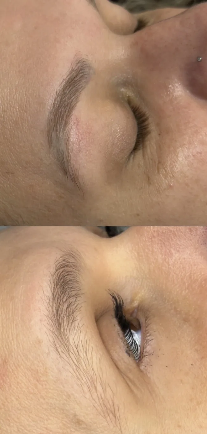 Remoção de micropigmentação, antes e depois