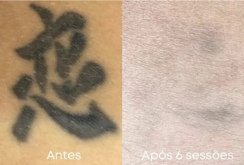 Trabalho realizado, remoção de tatuagem