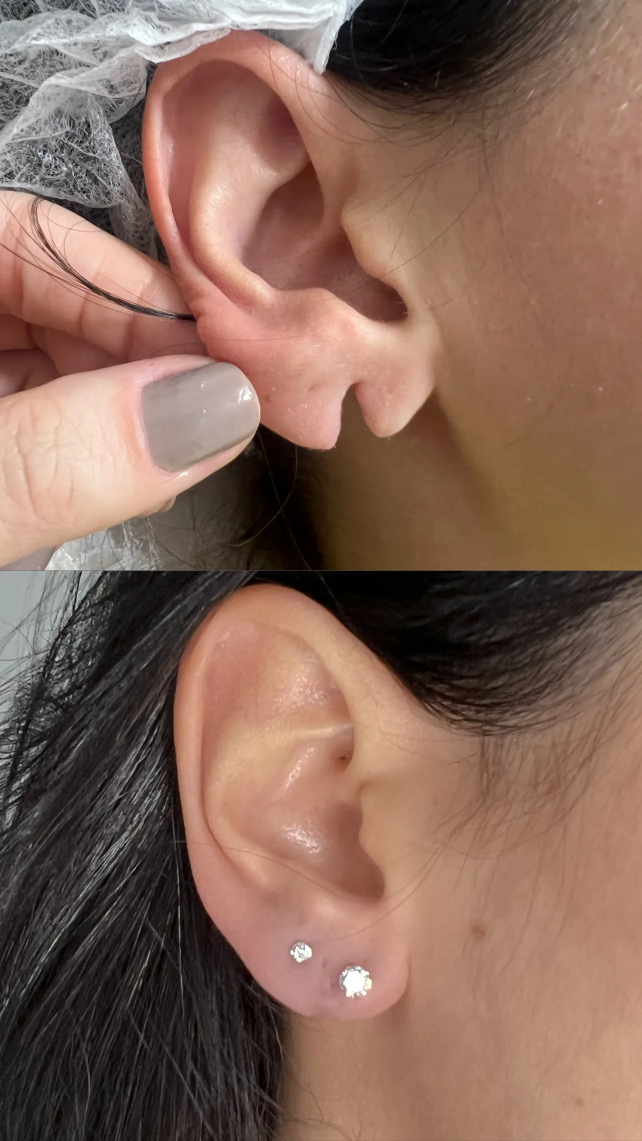 Trabalho realizado, lobuloplastia, antes e depois